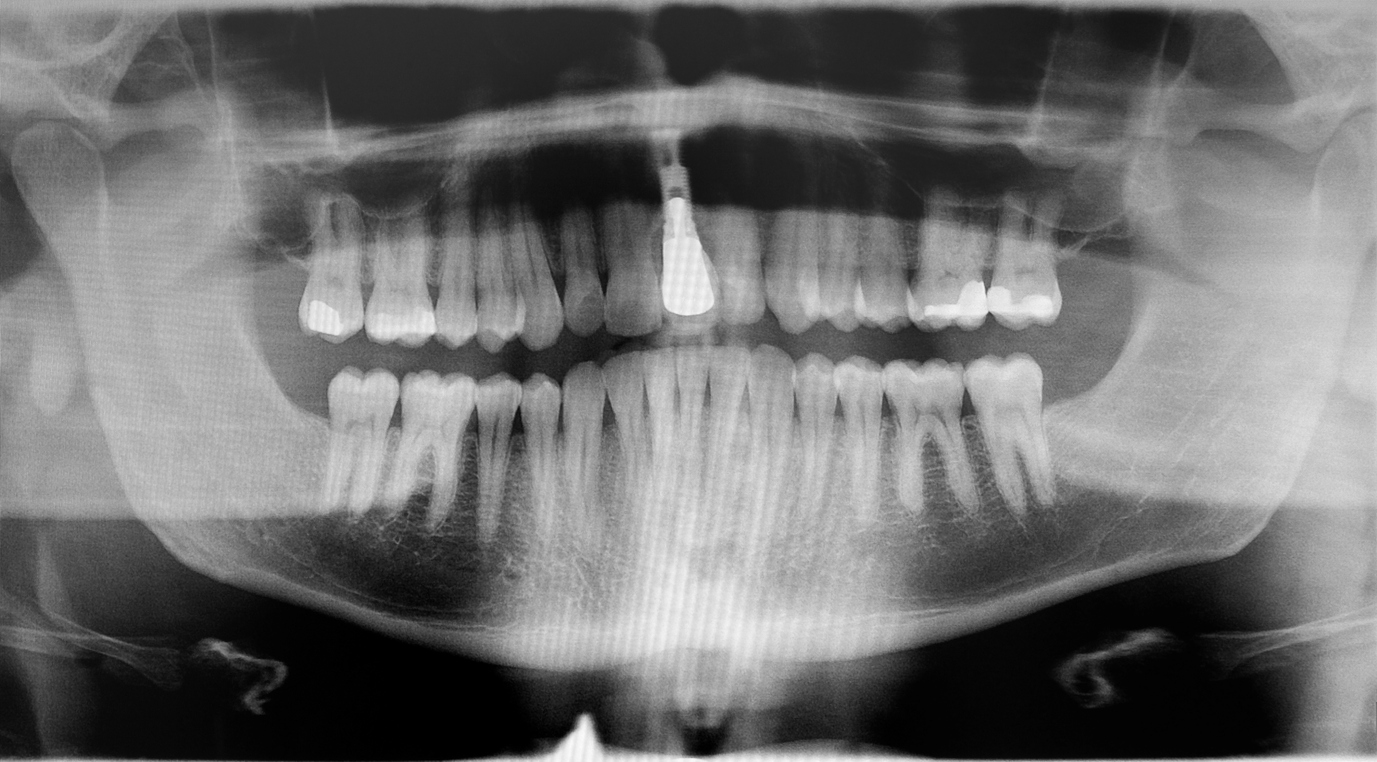 Digital Dental X-ray
